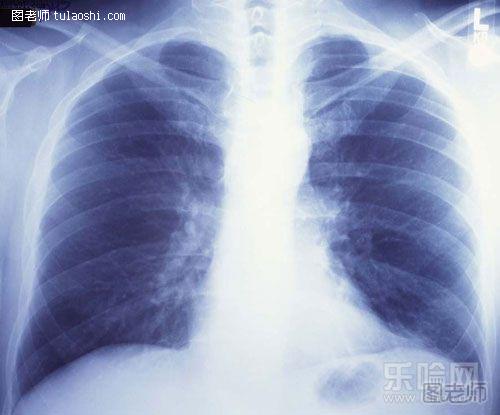 拍片能检查出什么类型的肺癌